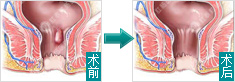 痔疮手术前后对比